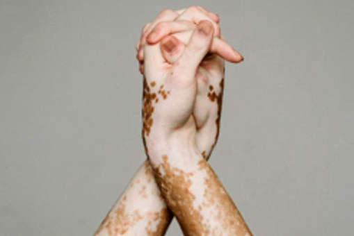 About Vitiligo