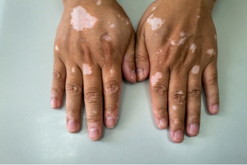 Get treatment for Vitiligo in India