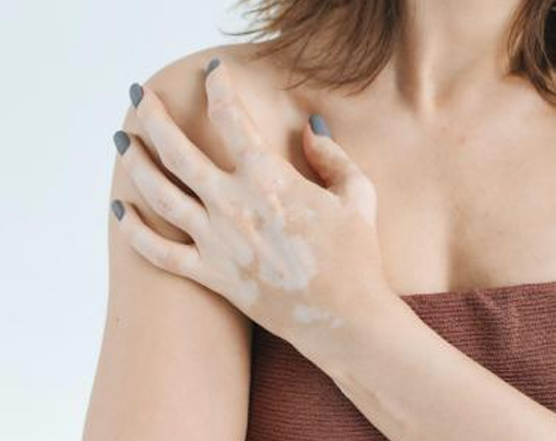 Top Vitiligo Homeopathic Treatment in India