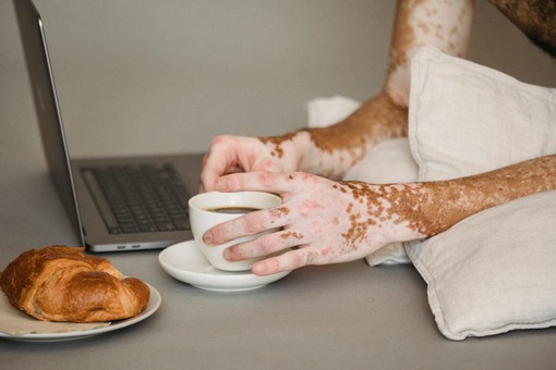 combining homeopathy and lifestyle changes for vitiligo treatment