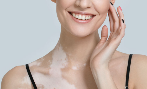 VITILIGO SKIN