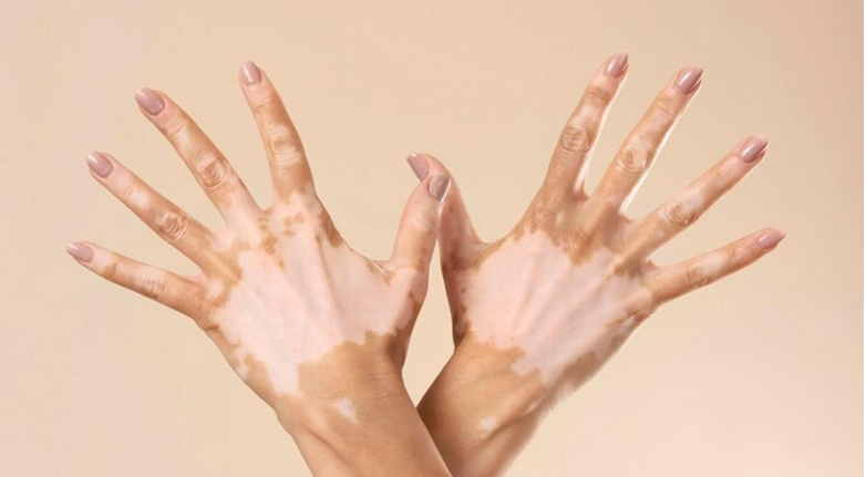 vitiligo-treatment