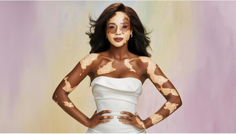 vitiligo model
