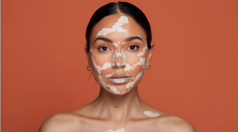 vitiligo face