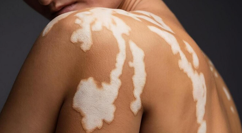 vitiligo skincare