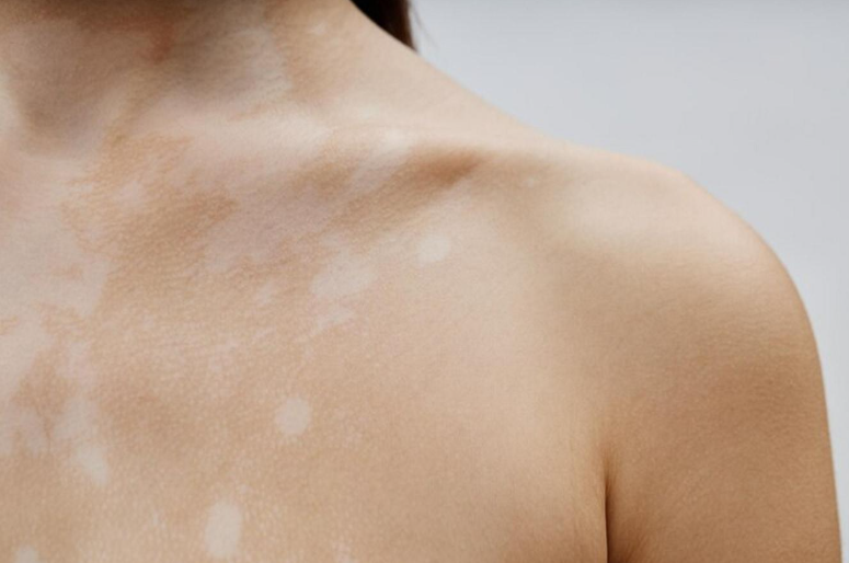 Vitiligo skin