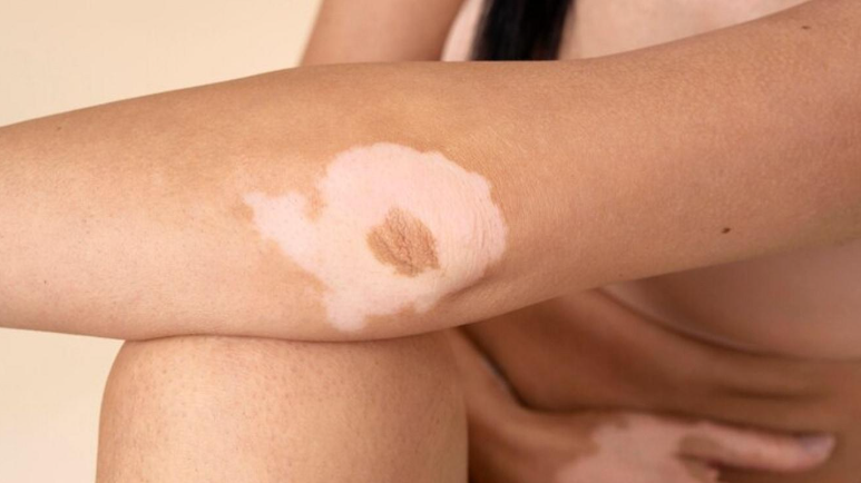 vitiligo hand