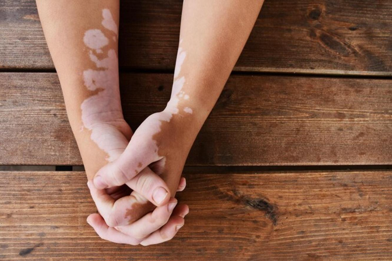 Vitiligo hand