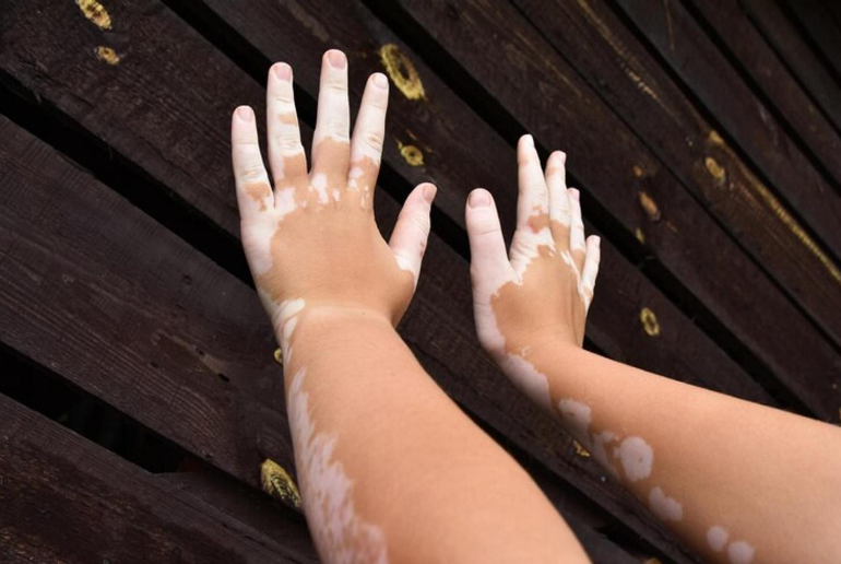 vitiligo Hand