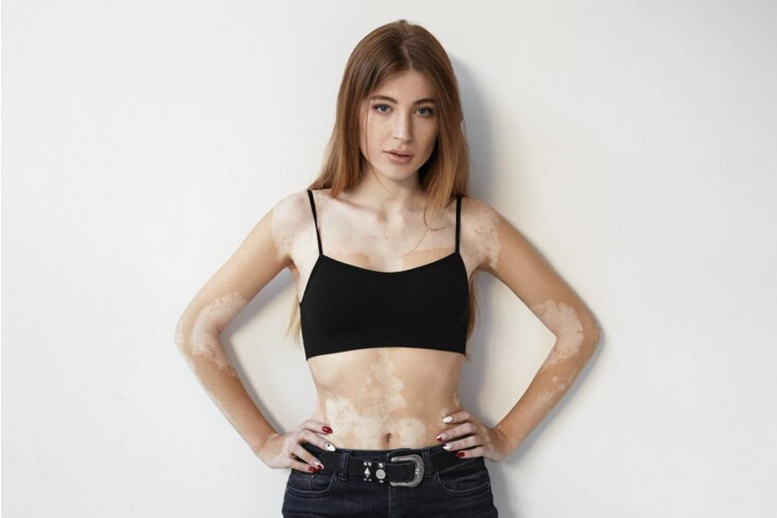vitiligo model