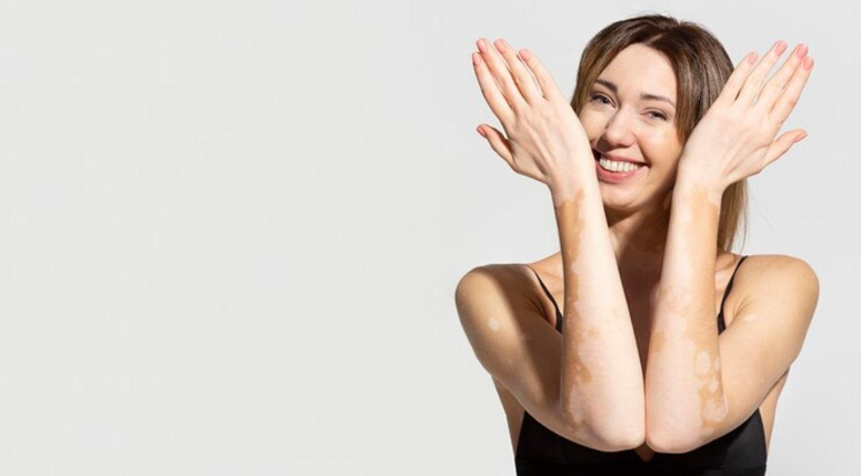 Vitiligo women