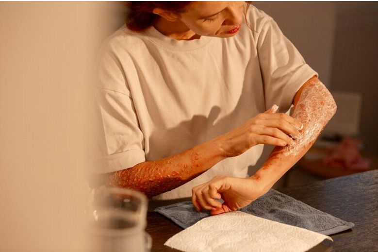 vitiligo cream
