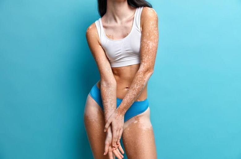 vitiligo skin