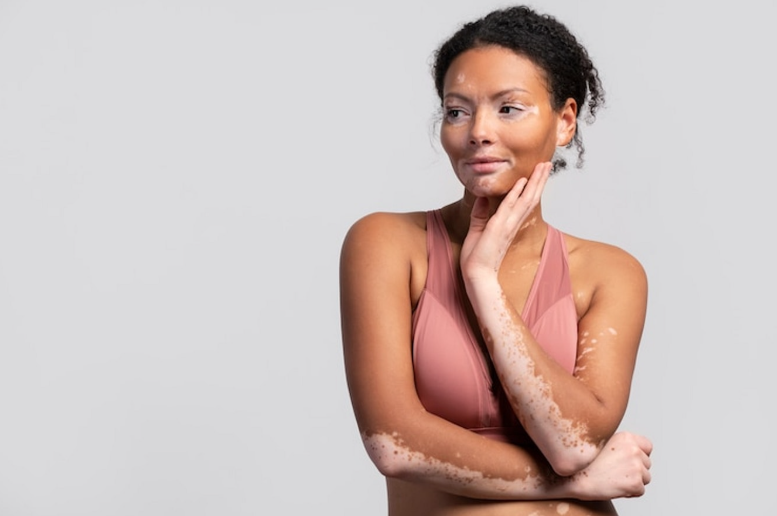 vitiligo women