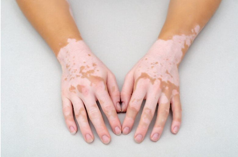 skin Vitiligo