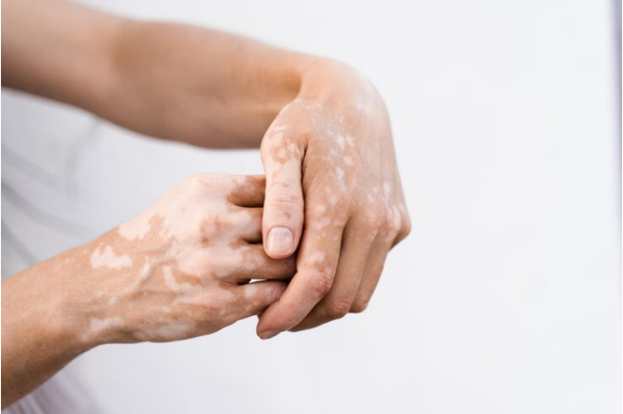 vitiligo hand