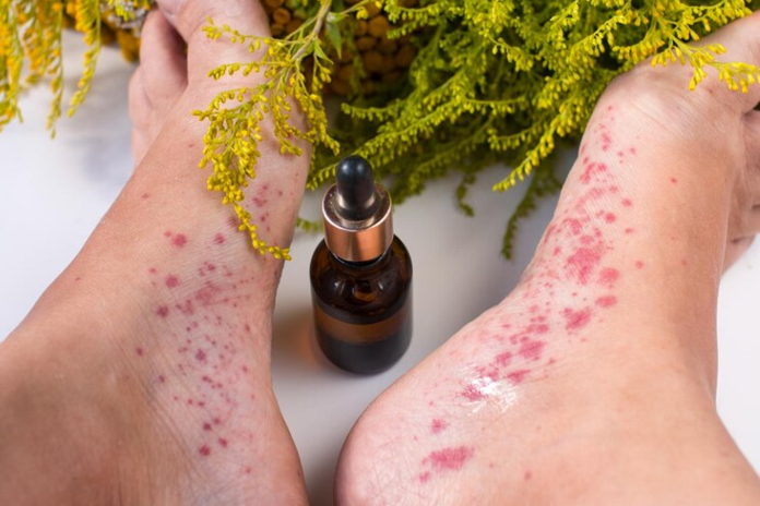 Vitiligo oils