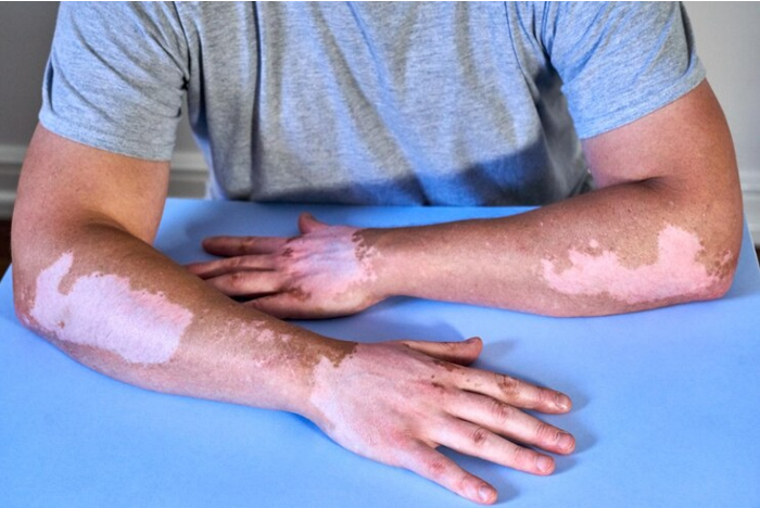 vitiligo skin patch
