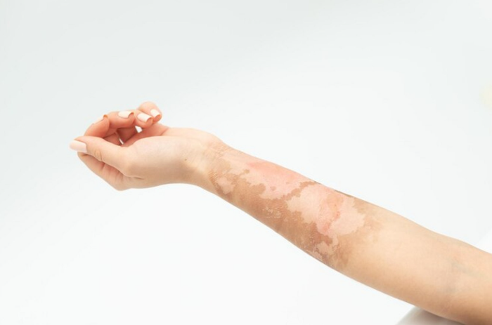 vitiligo hand