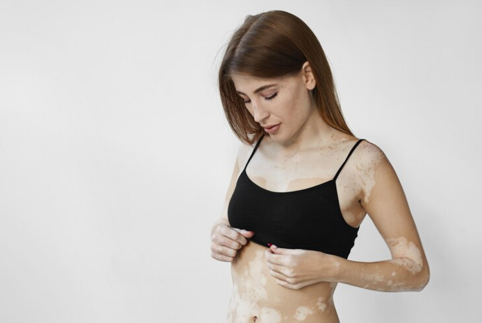 vitiligo women