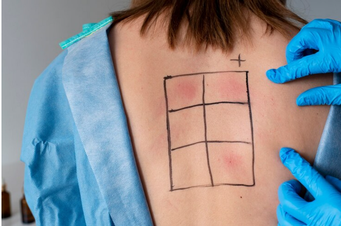 vitiligo patch