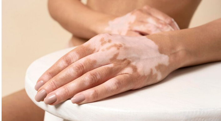 vitiligo hand
