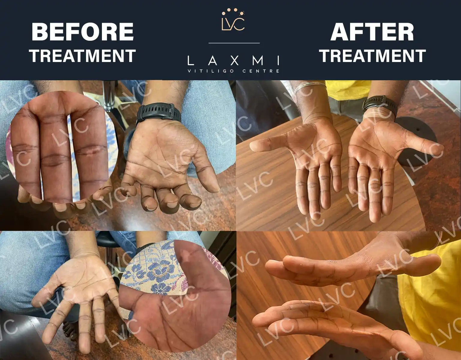 The best treatment for vitiligo helped a patient achieve a full vitiligo cure when treatment was started early.