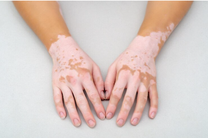 Vitiligo skin