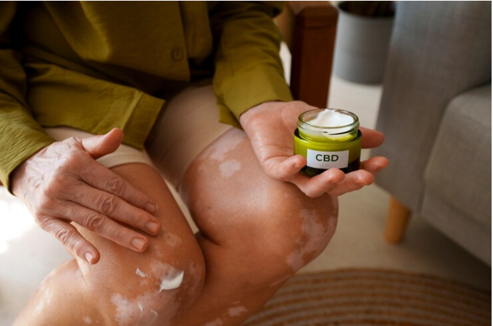 vitiligo cream