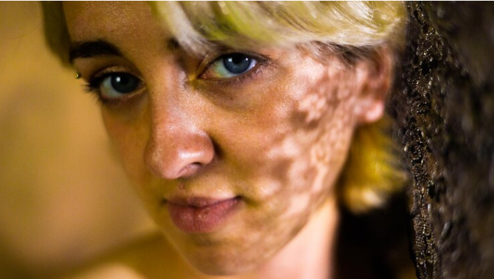 vitiligo face