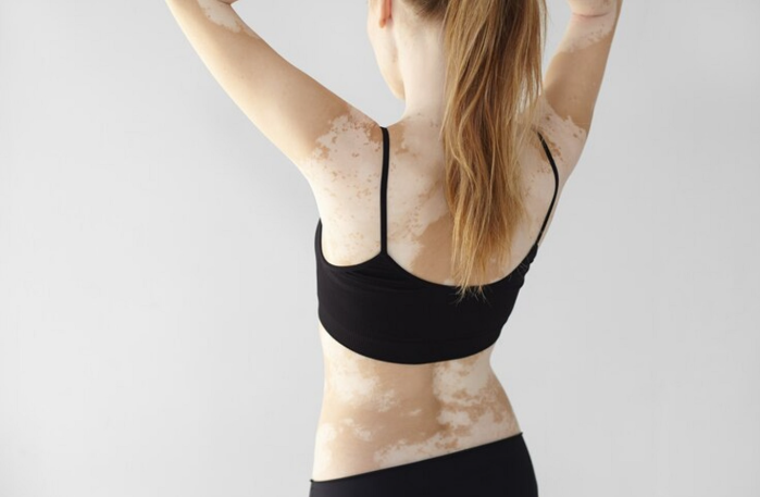 body vitiligo