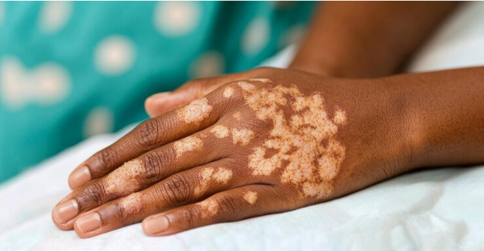 hand vitiligo
