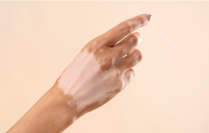 hand vitiligo