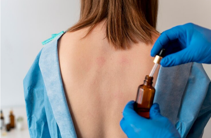 vitiligo oil