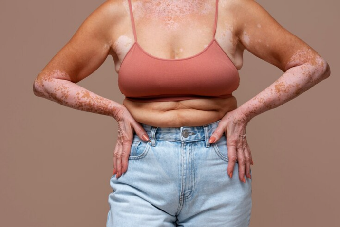 vitiligo body