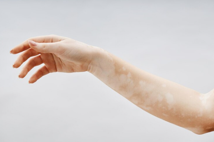 vitiligo hand