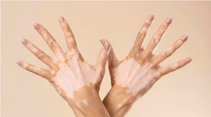 vitiligo-treatment
