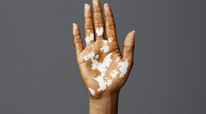 vitiligo hand