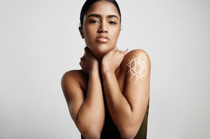 vitiligo women