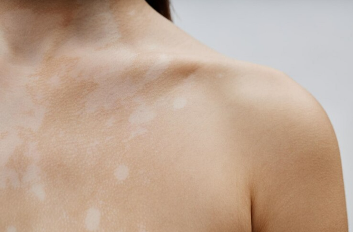 vitiligo skin