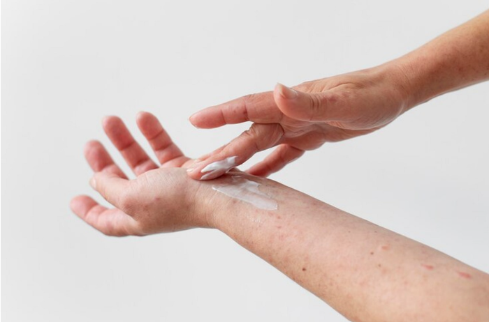 vitiligo cream