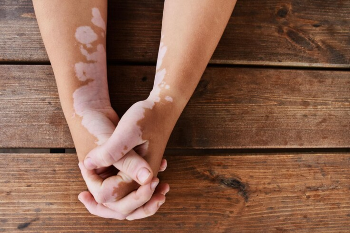 vitiligo hand