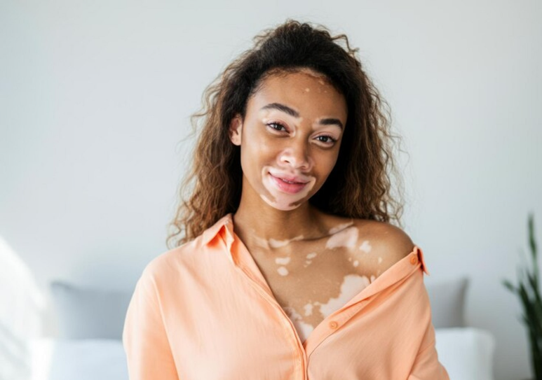 vitiligo women