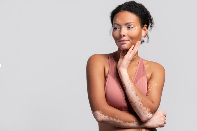VITILIGO BODY