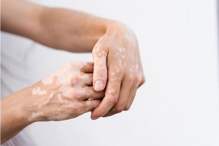 vitiligo hand