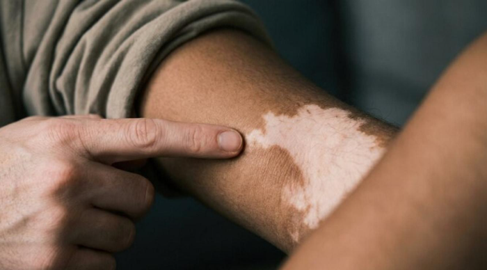 vitiligo