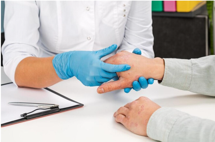vitiligo-treatment