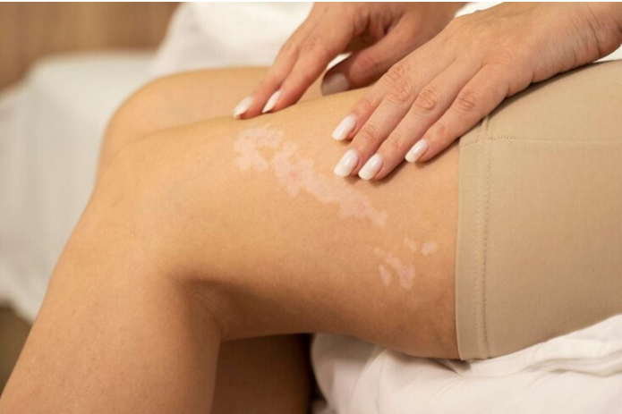 vitiligo skin