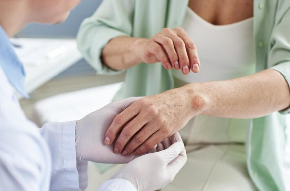 Vitiligo treatment