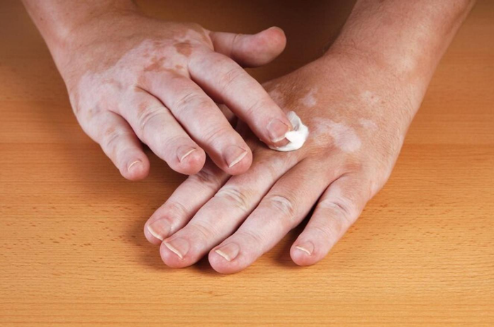 Vitiligo cream